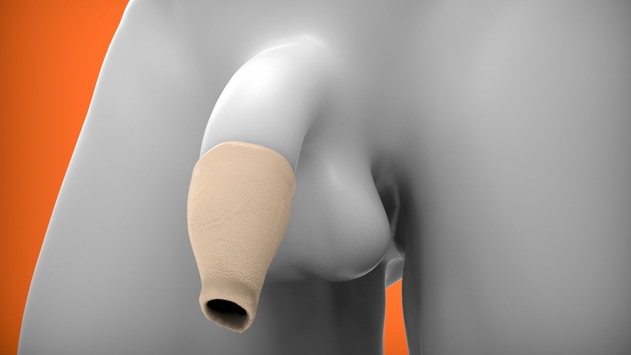 Oxballs Hood Moreskin Foreskin Set